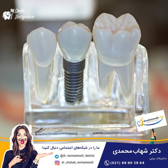 بعد از چند سال که دندانم را کشیدم می خواهم ایمپلنت کنم مشکلی نیست؟ - کلینیک دندانپزشکی دکتر شهاب محمدی